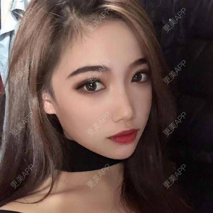 更美 - 翘了个腿的自体脂肪全面部填充经验 | 自体脂肪全面部填充 | 杭州