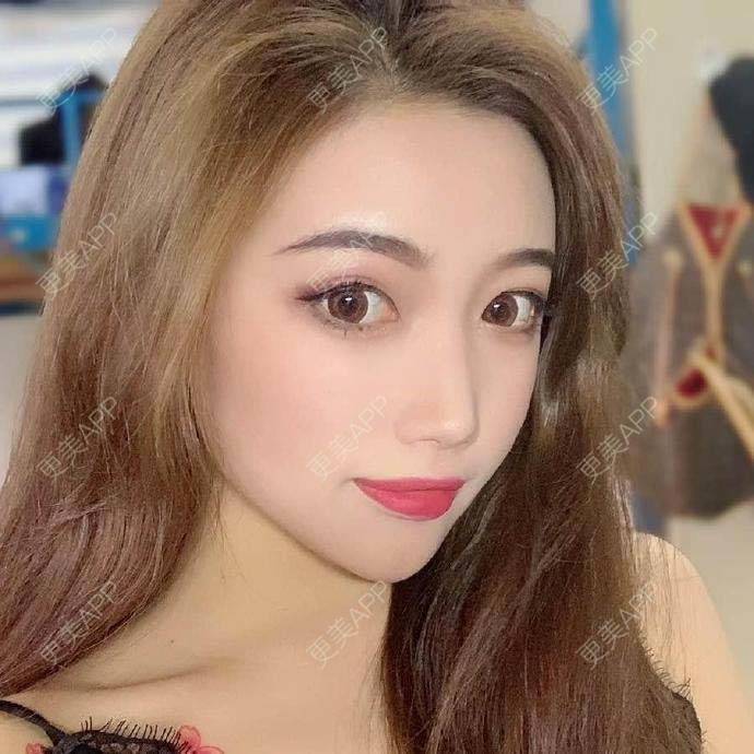 更美 - 翘了个腿的自体脂肪全面部填充经验 | 自体脂肪全面部填充 | 杭州