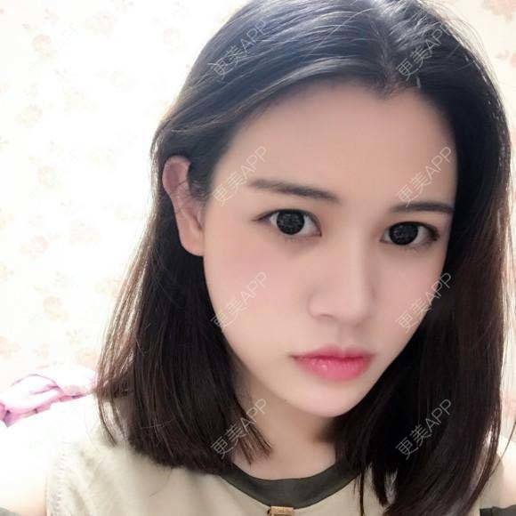 更美 - 烧范儿的自体脂肪全面部填充经验 | 自体脂肪全面部填充 | 杭州