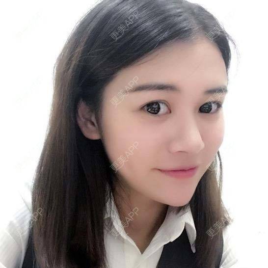 更美 - 烧范儿的自体脂肪全面部填充经验 | 自体脂肪全面部填充 | 杭州