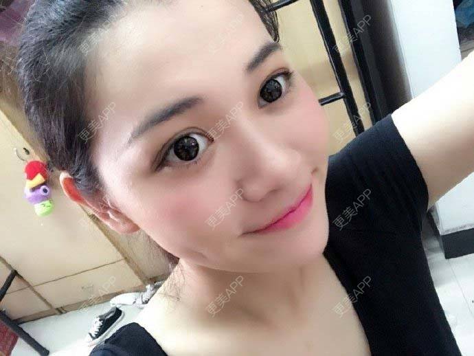 更美 - 烧范儿的自体脂肪全面部填充经验 | 自体脂肪全面部填充 | 杭州