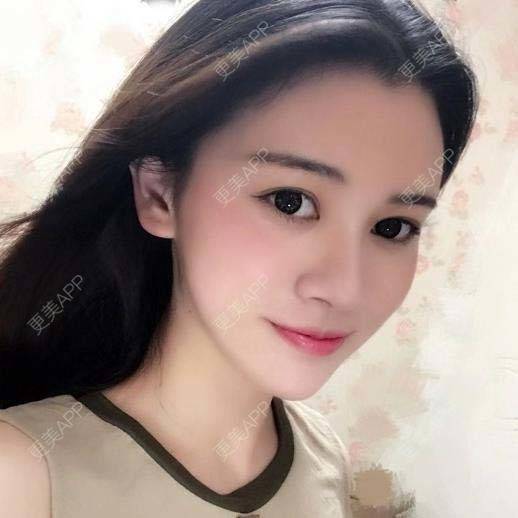 更美 - 烧范儿的自体脂肪全面部填充经验 | 自体脂肪全面部填充 | 杭州