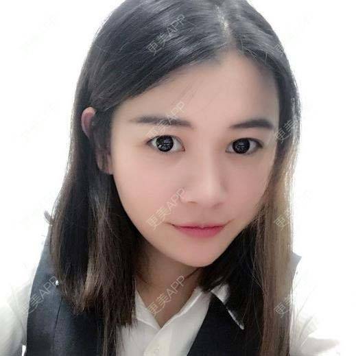 更美 - 烧范儿的自体脂肪全面部填充经验 | 自体脂肪全面部填充 | 杭州