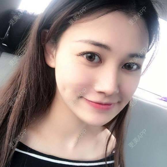 更美 - 烧范儿的自体脂肪全面部填充经验 | 自体脂肪全面部填充 | 杭州