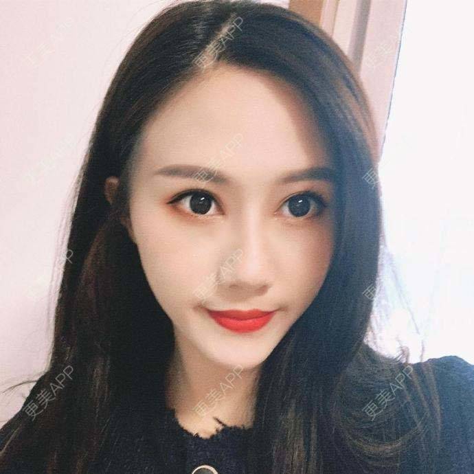 更美 - 烘焙呗的自体脂肪全面部填充经验 | 自体脂肪全面部填充 | 杭州