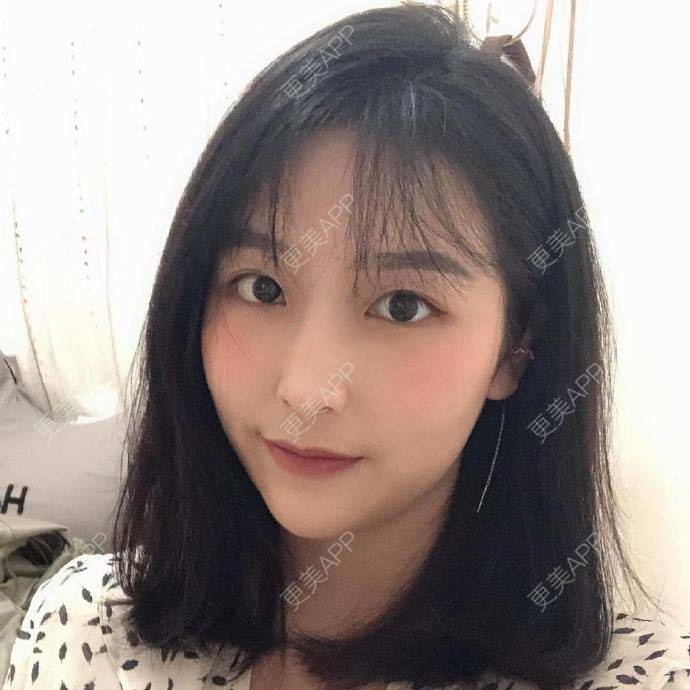 更美 - 尾刀的自体脂肪全面部填充经验 | 自体脂肪全面部填充 | 杭州