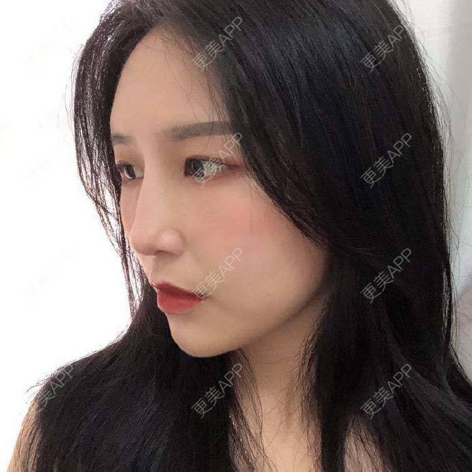 更美 - 尾刀的自体脂肪全面部填充经验 | 自体脂肪全面部填充 | 杭州