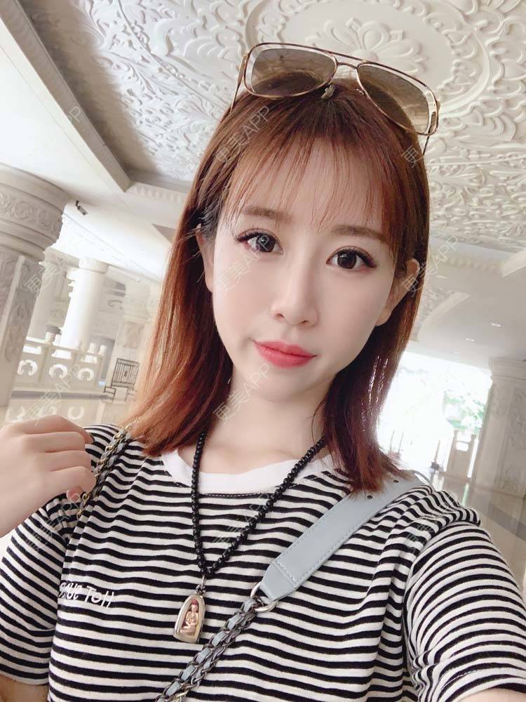 更美 - 更美用户PbmPgI4oPN的玻尿酸鼻部经验 | 玻尿酸鼻部 | 玻尿酸额头 | 玻尿酸太阳穴 | 玻尿酸法令纹 | 玻尿酸面部细纹