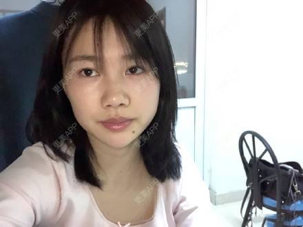 更美 - 热爱流浪的少女的肋软骨隆鼻经验 | 肋软骨隆鼻 | 武汉