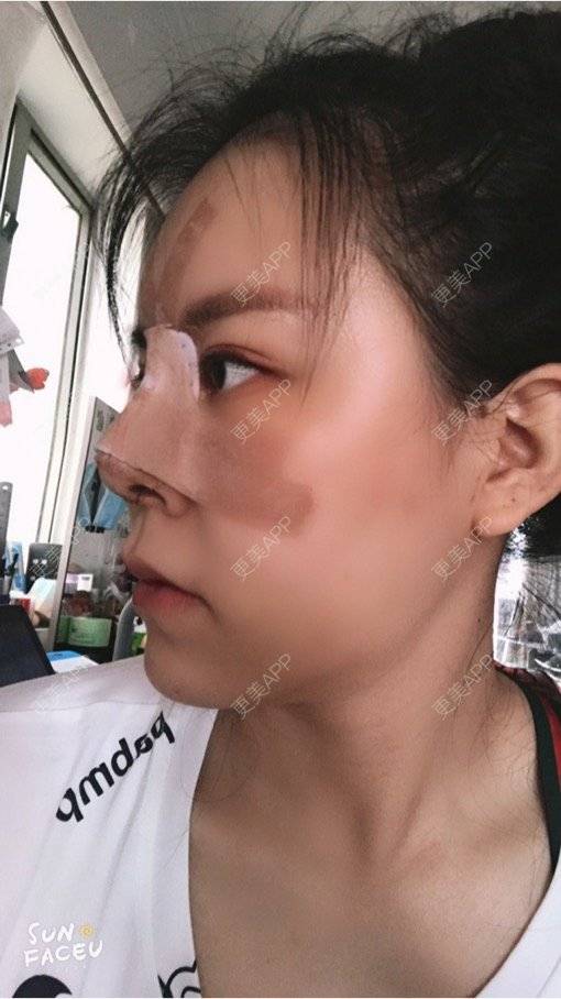 更美 - 更美用户iuB00h31N3的鼻部多项经验 | 肋软骨隆鼻 | 鼻部多项 | 广州