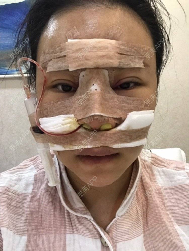 更美 - 更美用户iuB00h31N3的鼻部多项经验 | 肋软骨隆鼻 | 鼻部多项 | 广州
