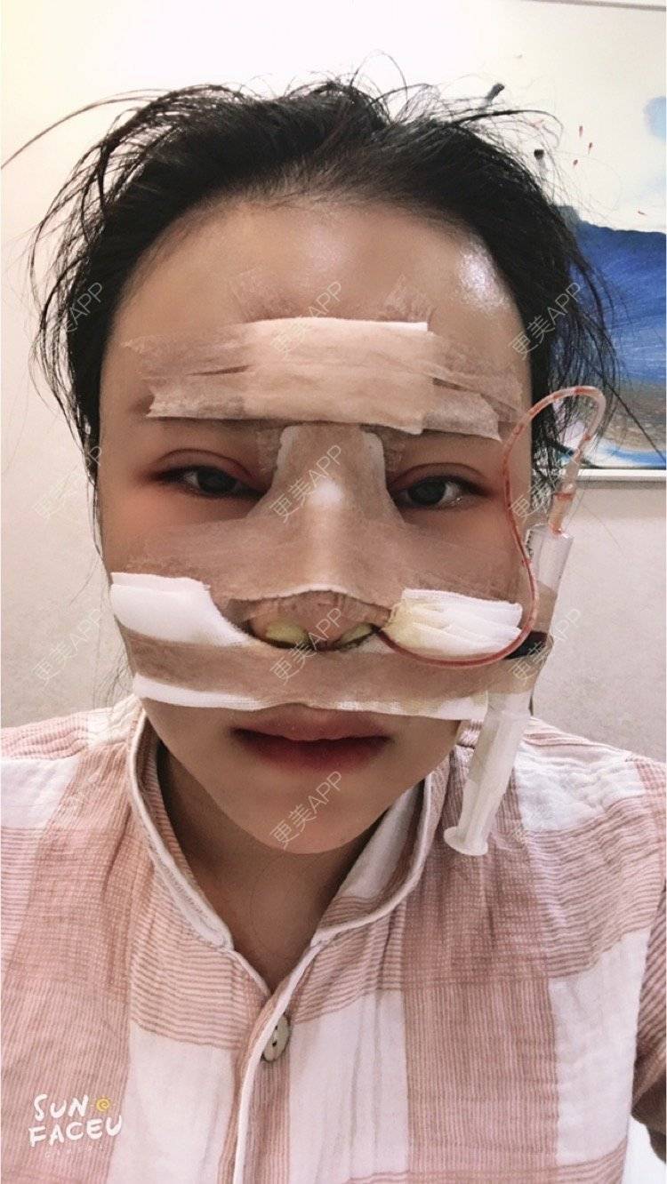更美 - 更美用户iuB00h31N3的鼻部多项经验 | 肋软骨隆鼻 | 鼻部多项 | 广州