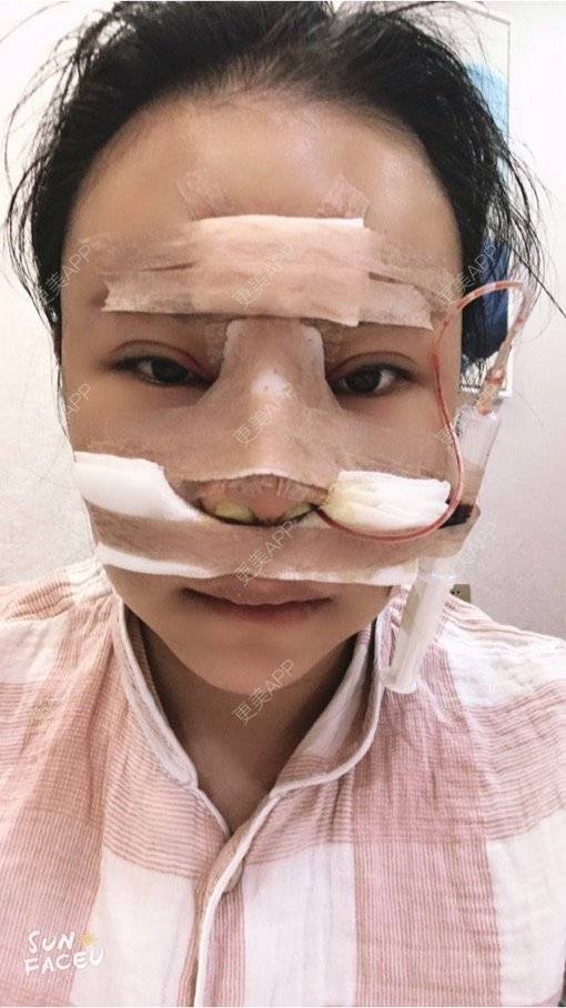 更美 - 更美用户iuB00h31N3的鼻部多项经验 | 肋软骨隆鼻 | 鼻部多项 | 广州