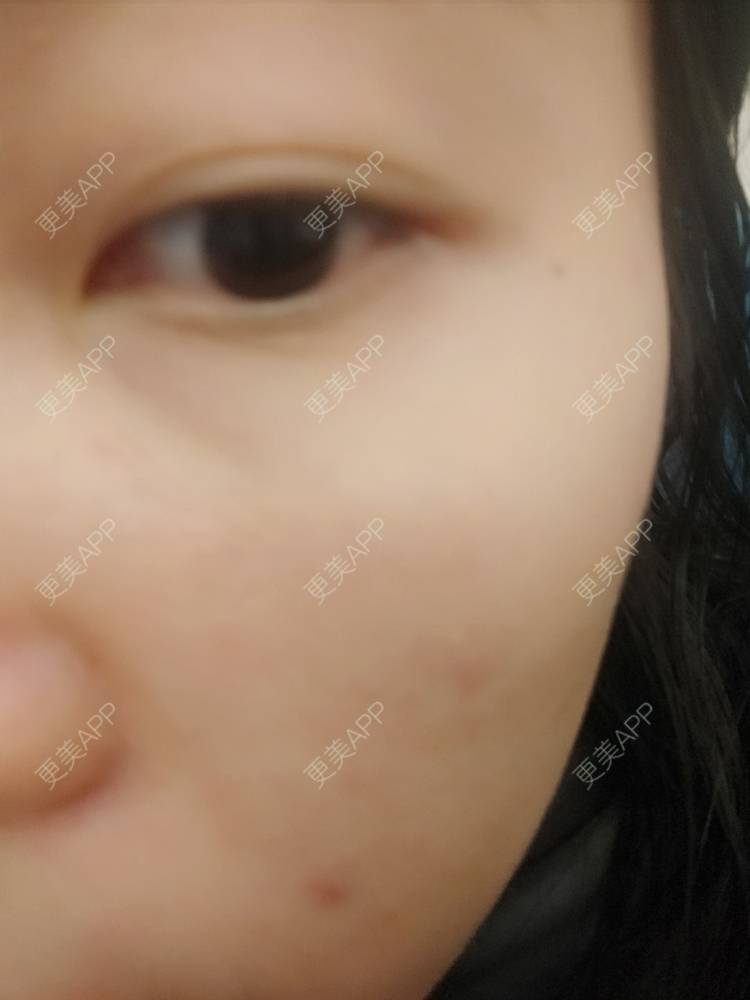 更美 - 更美用户EfbOT2IoXt的激光淡化黑眼圈经验 | 激光淡化黑眼圈 | 重庆