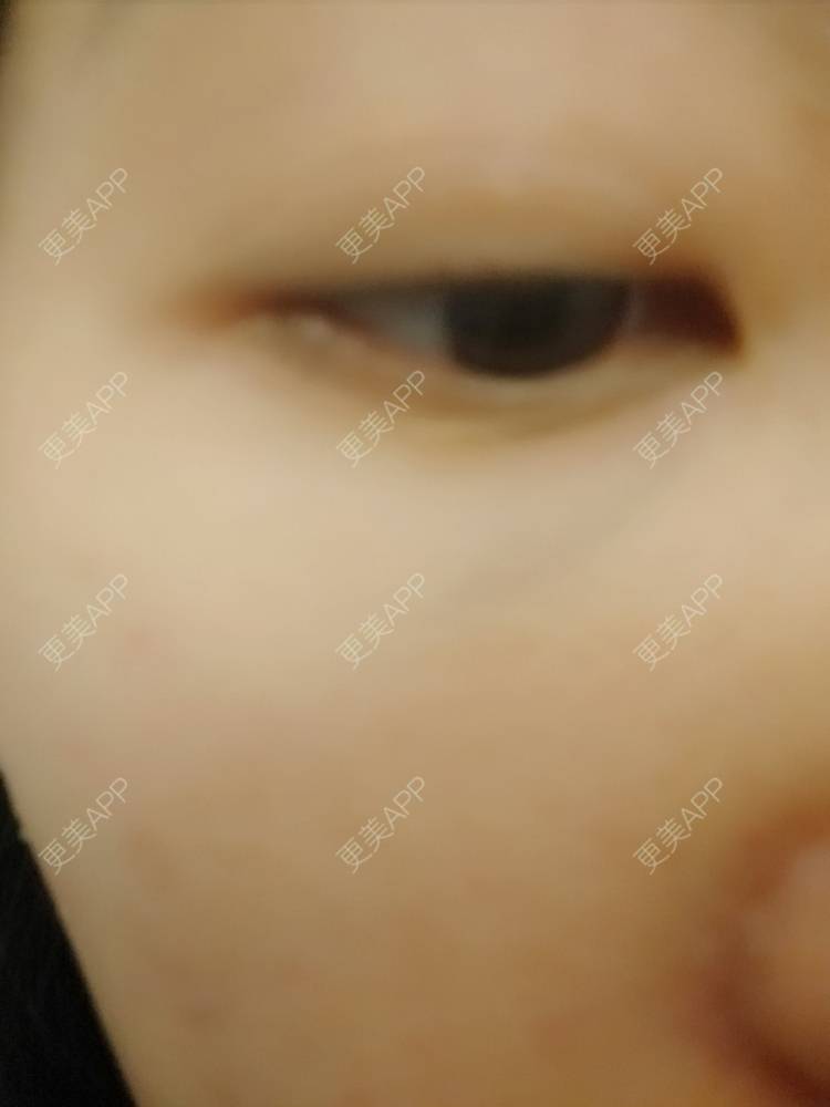 更美 - 更美用户EfbOT2IoXt的激光淡化黑眼圈经验 | 激光淡化黑眼圈 | 重庆