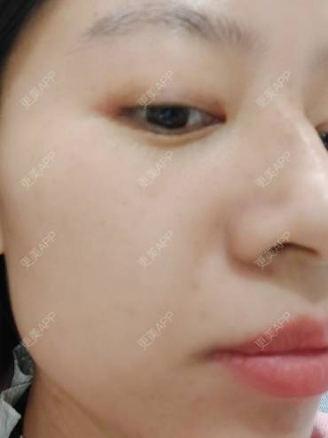 更美 - 更美用户FKgNeqD2Py的黑脸娃娃经验 | 光子嫩肤 | 黑脸娃娃 | 镭射净肤 | 彩光嫩肤 | 美白套餐 | 点阵激光 | 注射美白 | 果酸焕肤 | 激光淡斑 | 重庆