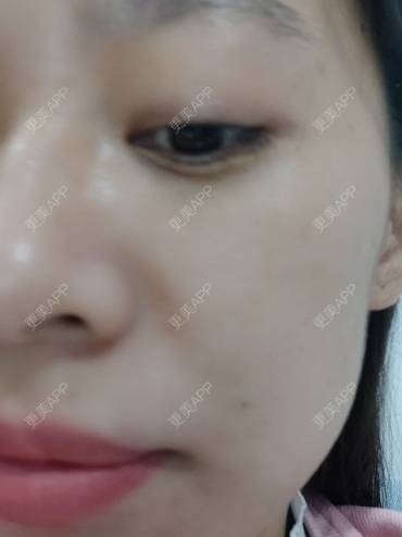 更美 - 更美用户FKgNeqD2Py的黑脸娃娃经验 | 光子嫩肤 | 黑脸娃娃 | 镭射净肤 | 彩光嫩肤 | 美白套餐 | 点阵激光 | 注射美白 | 果酸焕肤 | 激光淡斑 | 重庆