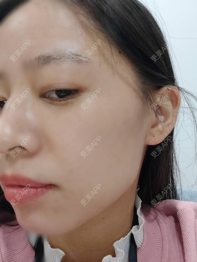 更美 - 更美用户FKgNeqD2Py的黑脸娃娃经验 | 光子嫩肤 | 黑脸娃娃 | 镭射净肤 | 彩光嫩肤 | 美白套餐 | 点阵激光 | 注射美白 | 果酸焕肤 | 激光淡斑 | 重庆