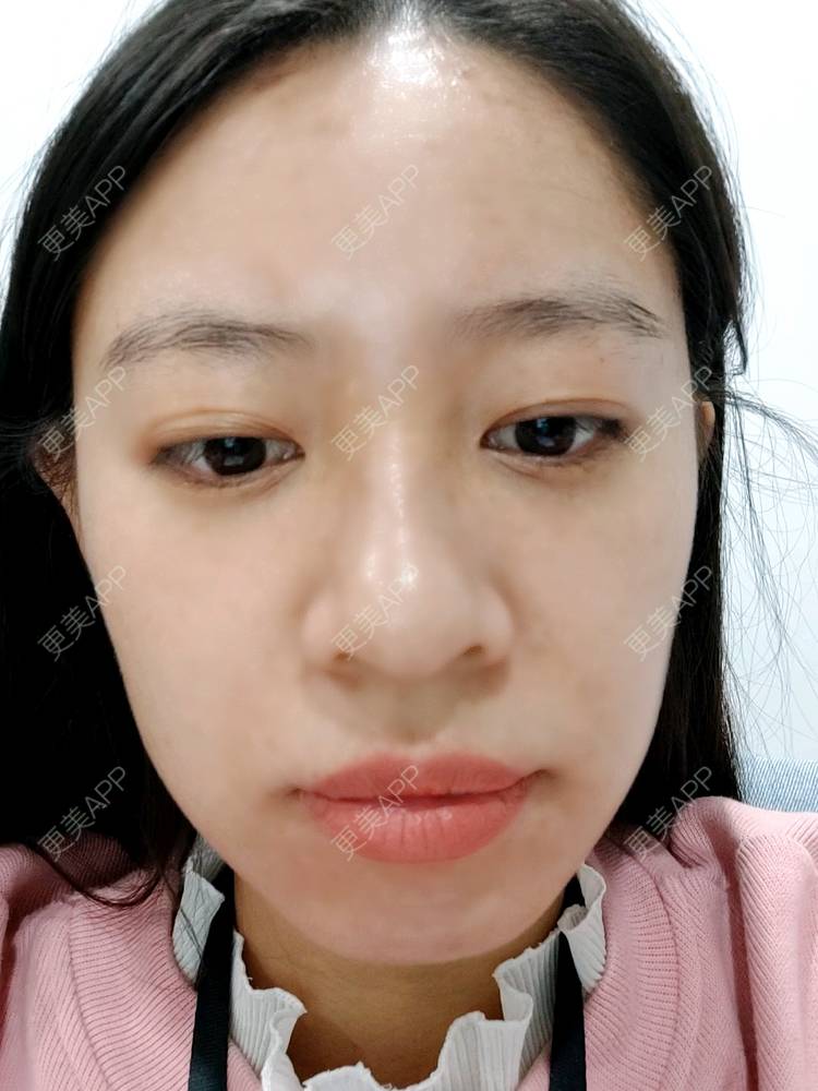 更美 - 更美用户FKgNeqD2Py的黑脸娃娃经验 | 光子嫩肤 | 黑脸娃娃 | 镭射净肤 | 彩光嫩肤 | 美白套餐 | 点阵激光 | 注射美白 | 果酸焕肤 | 激光淡斑 | 重庆