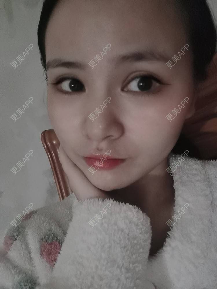 更美 - 耿直girl在线的鼻部多项经验 | 耳软骨隆鼻 | 肋软骨隆鼻 | 自体软骨垫鼻尖 | 鼻部多项 | 鼻小柱延长 | 膨体隆鼻 | 鼻中隔软骨垫鼻头 | 鼻中隔软骨隆鼻 | 垫鼻尖 | 人工骨隆鼻