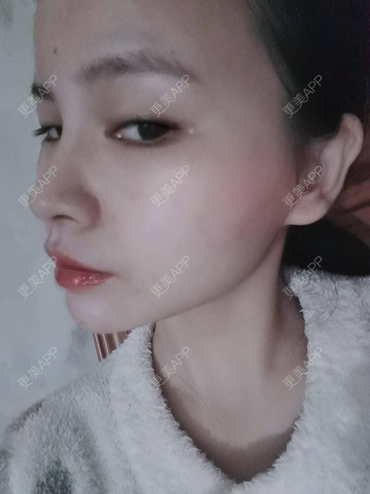 更美 - 耿直girl在线的鼻部多项经验 | 耳软骨隆鼻 | 肋软骨隆鼻 | 自体软骨垫鼻尖 | 鼻部多项 | 鼻小柱延长 | 膨体隆鼻 | 鼻中隔软骨垫鼻头 | 鼻中隔软骨隆鼻 | 垫鼻尖 | 人工骨隆鼻