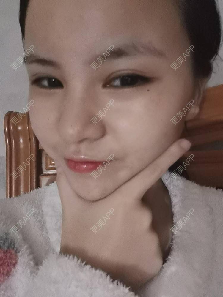 更美 - 耿直girl在线的鼻部多项经验 | 耳软骨隆鼻 | 肋软骨隆鼻 | 自体软骨垫鼻尖 | 鼻部多项 | 鼻小柱延长 | 膨体隆鼻 | 鼻中隔软骨垫鼻头 | 鼻中隔软骨隆鼻 | 垫鼻尖 | 人工骨隆鼻