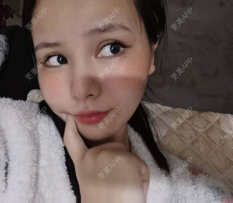 更美 - 耿直girl在线的鼻部多项经验 | 耳软骨隆鼻 | 肋软骨隆鼻 | 自体软骨垫鼻尖 | 鼻部多项 | 鼻小柱延长 | 膨体隆鼻 | 鼻中隔软骨垫鼻头 | 鼻中隔软骨隆鼻 | 垫鼻尖 | 人工骨隆鼻