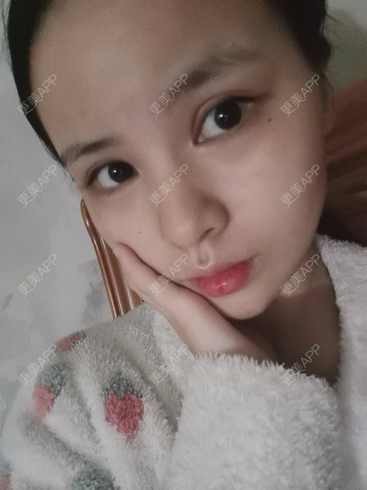 更美 - 耿直girl在线的鼻部多项经验 | 耳软骨隆鼻 | 肋软骨隆鼻 | 自体软骨垫鼻尖 | 鼻部多项 | 鼻小柱延长 | 膨体隆鼻 | 鼻中隔软骨垫鼻头 | 鼻中隔软骨隆鼻 | 垫鼻尖 | 人工骨隆鼻