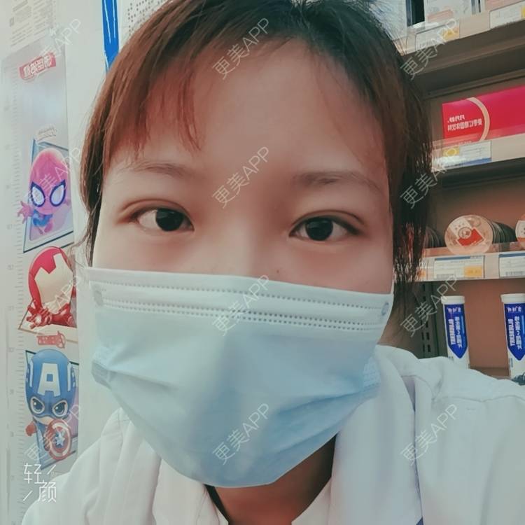 更美 - 更美用户tbs28rKiLZ的定点双眼皮经验 | 定点双眼皮 | 杭州