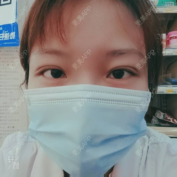 更美 - 更美用户tbs28rKiLZ的定点双眼皮经验 | 定点双眼皮 | 杭州