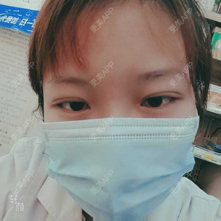 更美 - 更美用户tbs28rKiLZ的定点双眼皮经验 | 定点双眼皮 | 杭州