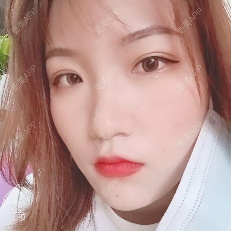 更美 - 更美用户tbs28rKiLZ的定点双眼皮经验 | 定点双眼皮 | 杭州