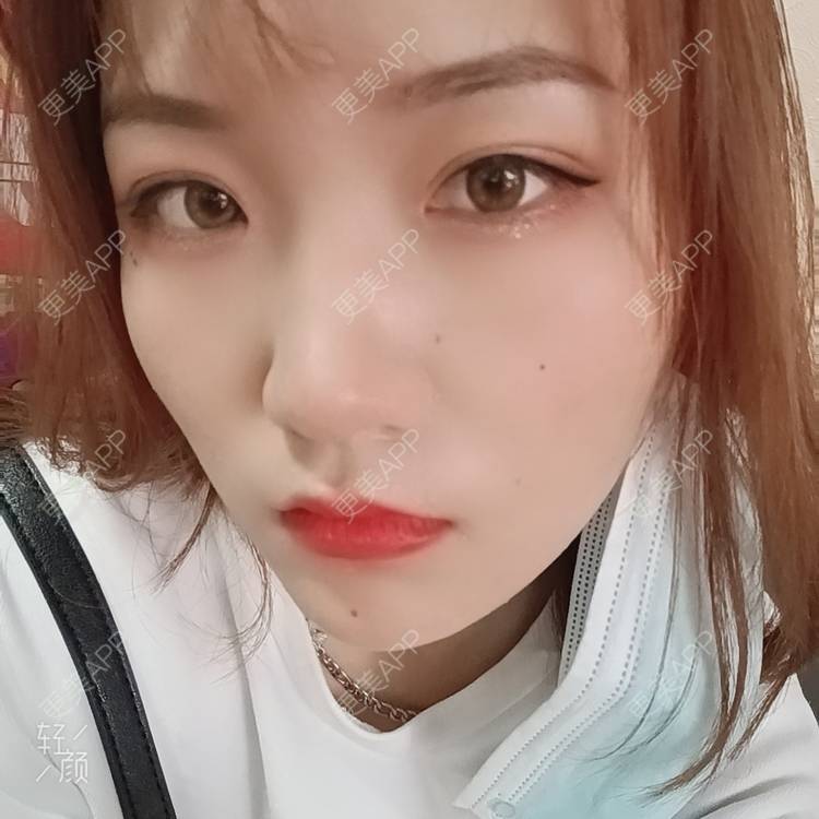 更美 - 更美用户tbs28rKiLZ的定点双眼皮经验 | 定点双眼皮 | 杭州