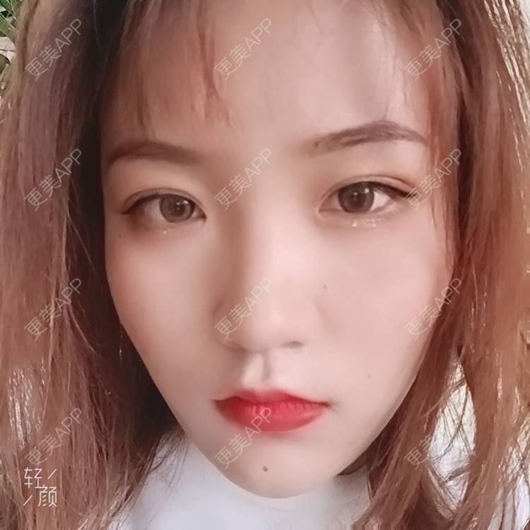 更美 - 更美用户tbs28rKiLZ的定点双眼皮经验 | 定点双眼皮 | 杭州