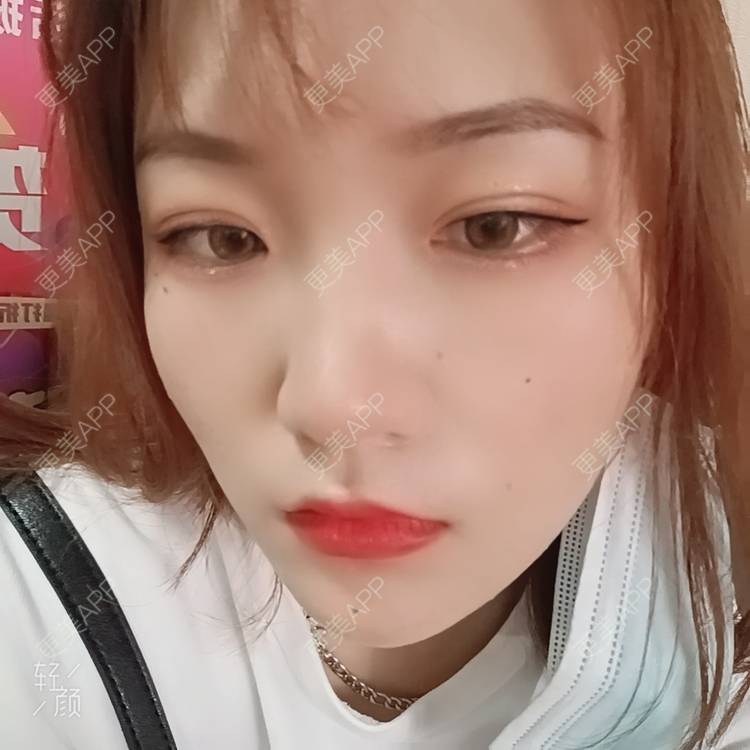 更美 - 更美用户tbs28rKiLZ的定点双眼皮经验 | 定点双眼皮 | 杭州