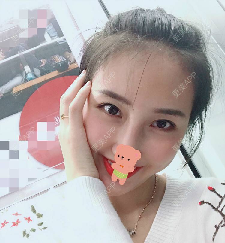 更美 - 更美用户1ieoNiY7aB的植发际线经验 | 北京 | 植发际线 | 毛发移植