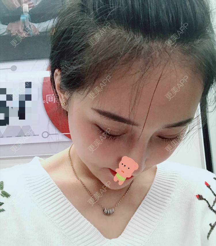 更美 - 更美用户1ieoNiY7aB的植发际线经验 | 北京 | 植发际线 | 毛发移植