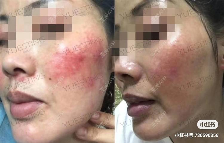 更美 - 悦丝汀，修复敏感肌的舒敏之星经验 | 舒敏之星 | 成都