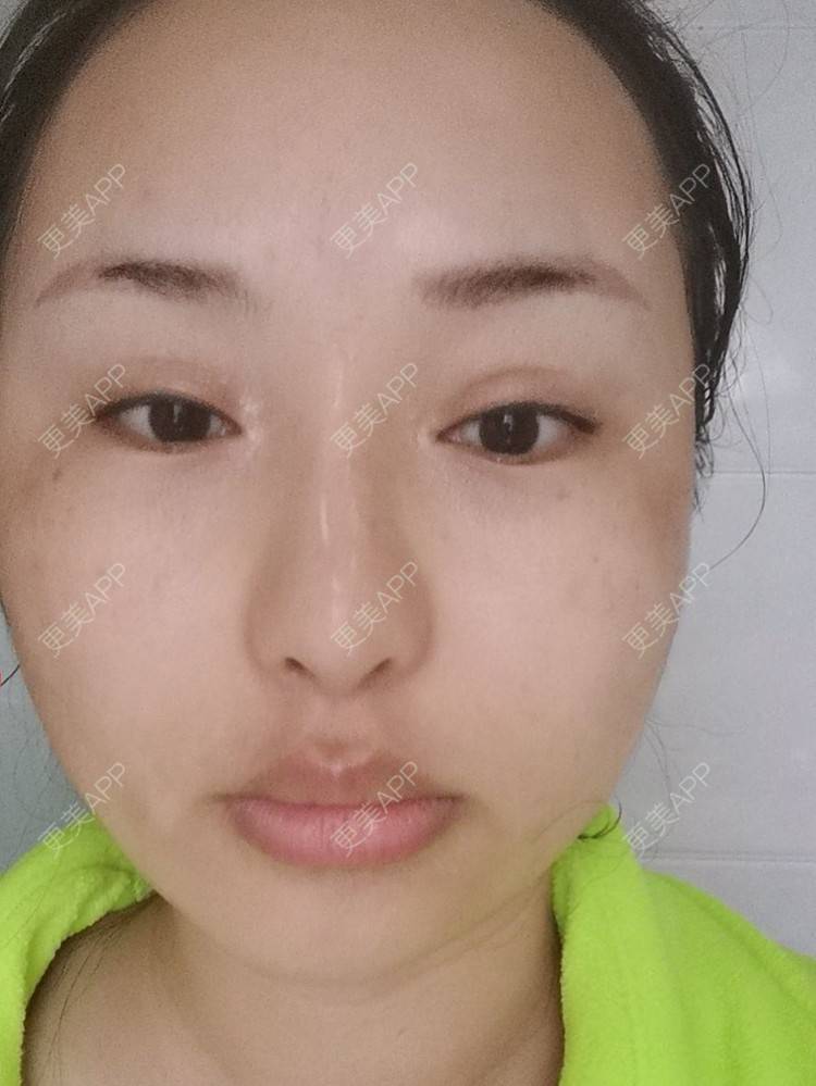 更美 - 沉沉mm的吸脂瘦脸经验 | 全脸整形套餐 | V脸套餐 | 射频溶脂瘦脸 | 激光溶脂瘦脸 | 注射溶脂瘦脸 | 吸脂瘦脸 | 自体脂肪丰面颊 | 吸脂 | 腰腹吸脂 | 背部吸脂 | 手臂吸脂 | 玻尿酸面颊 | 胶原蛋白丰面颊 | 面部不对称矫正