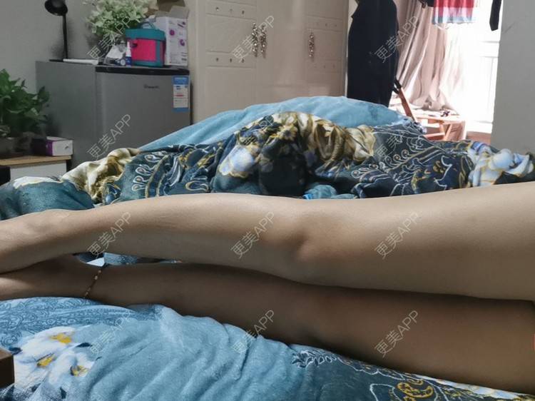 更美 - 沉沉mm的吸脂瘦脸经验 | 全脸整形套餐 | V脸套餐 | 射频溶脂瘦脸 | 激光溶脂瘦脸 | 注射溶脂瘦脸 | 吸脂瘦脸 | 自体脂肪丰面颊 | 吸脂 | 腰腹吸脂 | 背部吸脂 | 手臂吸脂 | 玻尿酸面颊 | 胶原蛋白丰面颊 | 面部不对称矫正