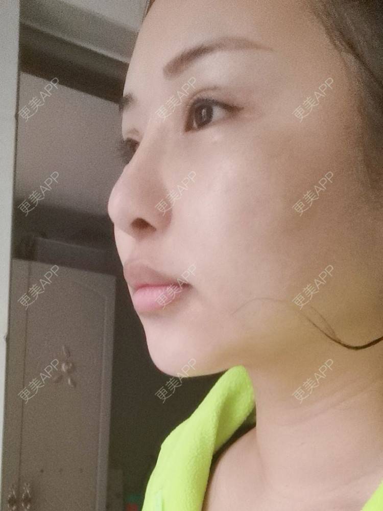 更美 - 沉沉mm的吸脂瘦脸经验 | 全脸整形套餐 | V脸套餐 | 射频溶脂瘦脸 | 激光溶脂瘦脸 | 注射溶脂瘦脸 | 吸脂瘦脸 | 自体脂肪丰面颊 | 吸脂 | 腰腹吸脂 | 背部吸脂 | 手臂吸脂 | 玻尿酸面颊 | 胶原蛋白丰面颊 | 面部不对称矫正
