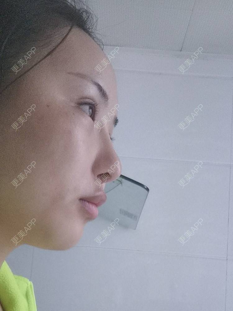 更美 - 沉沉mm的吸脂瘦脸经验 | 全脸整形套餐 | V脸套餐 | 射频溶脂瘦脸 | 激光溶脂瘦脸 | 注射溶脂瘦脸 | 吸脂瘦脸 | 自体脂肪丰面颊 | 吸脂 | 腰腹吸脂 | 背部吸脂 | 手臂吸脂 | 玻尿酸面颊 | 胶原蛋白丰面颊 | 面部不对称矫正