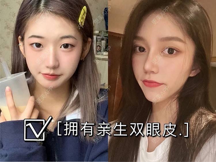 全切双眼皮前后对比照_更美用户csua6yajl7全切双眼皮前后对比照_术后