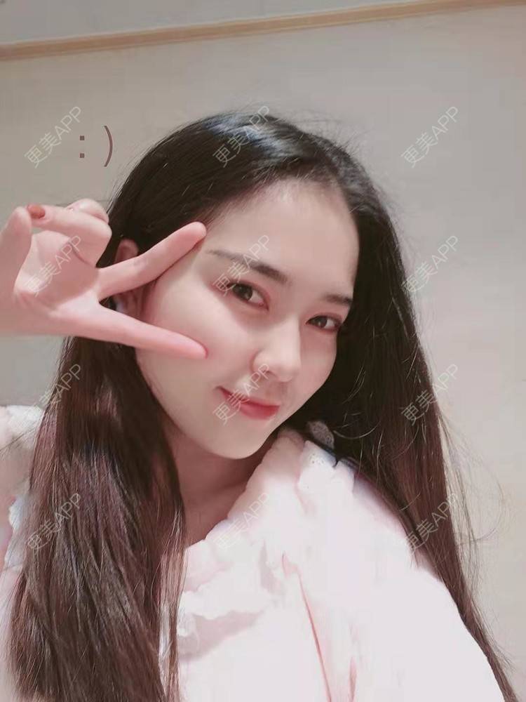 更美 - 更美用户uK1ce6rfue的全切双眼皮经验 | 广州 | 全切双眼皮