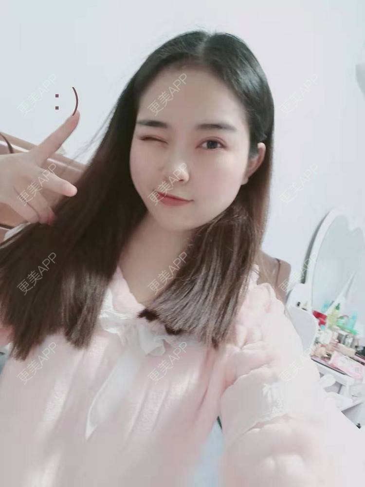 更美 - 更美用户uK1ce6rfue的全切双眼皮经验 | 广州 | 全切双眼皮