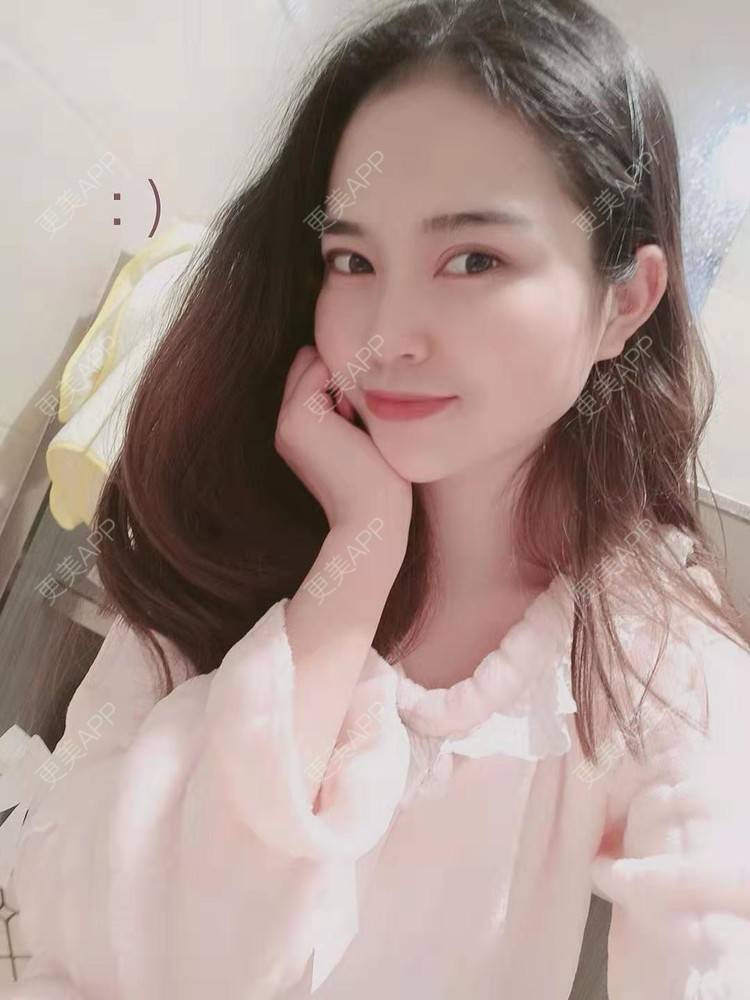 更美 - 更美用户uK1ce6rfue的全切双眼皮经验 | 广州 | 全切双眼皮