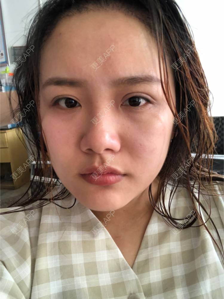 更美 - 奥多Ke。的植发际线经验 | 植发际线 | 南昌