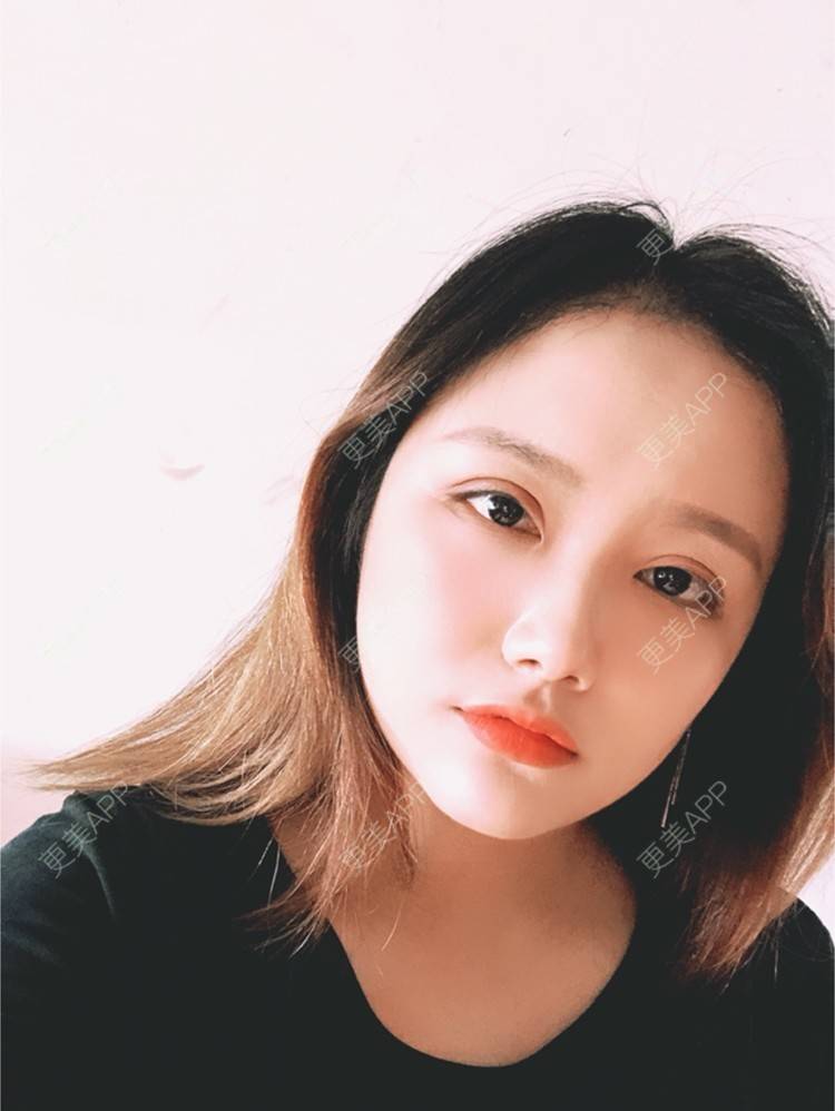 更美 - 奥多Ke。的植发际线经验 | 植发际线 | 南昌