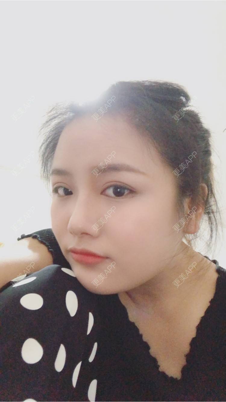 更美 - 奥多Ke。的植发际线经验 | 植发际线 | 南昌