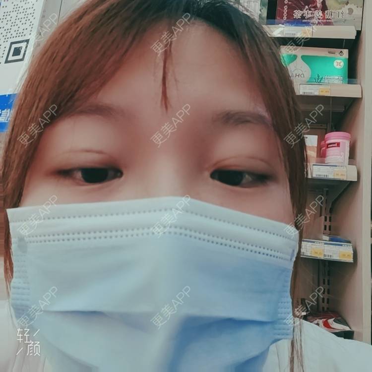 更美 - 更美用户tbs28rKiLZ的定点双眼皮经验 | 定点双眼皮 | 杭州